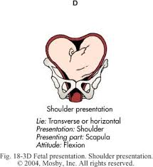 Image result for Shoulder Presentation