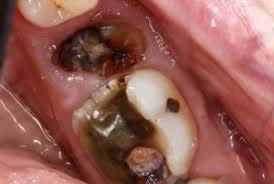 How to remove a broken tooth. Cracked Tooth Symptoms Causes Solutions Mccarl Dental Group