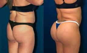 Top 5 plastic surgeries gone wrong nowadays everyone wants to look youthful and the easiest and 3:52. Brazilian Butt Lift Bbl Dr Rodriguez Cosmeticsurg Baltimore