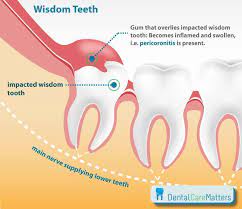 Maybe you would like to learn more about one of these? Klinik Pergigian I Pro Dental Surgery Cabutan Gigi Geraham Bongsu Wisdom Tooth Removal