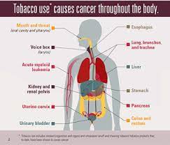 Lung cancer is the most common form of the disease in the world and 90 percent of all cases are caused by cigarette smoking. Cancers Linked To Tobacco Use Make Up 40 Of All Cancers Diagnosed In The United States Cdc Online Newsroom Cdc