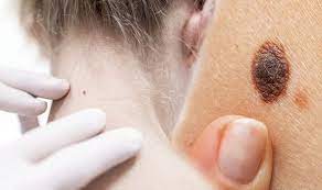 melanoma is a type of skin cancer that can spread to other organs in the body. Skin Cancer Changes In Moles Pink Growths Or Bowens Disease Are Signs Express Co Uk