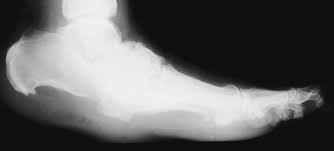 This type of nerve damage may prevent a person . Everything You Need To Know About Charcot Foot But Were Afraid To Ask