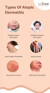 Image result for Atopic eczema atopic dermatitis