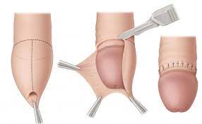 Dudas Sobre La Circuncision Urologo En Culiacan Dr Luis Guerra