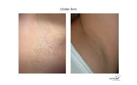 Posted on 12/15/2020 03/09/2021 by elite body and laser. Reasons To Love Laser Hair Removal At Celebrity Med Spa