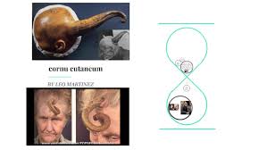 Image result for cornu cutaneum)