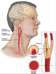 Carotid artery disease is caused by a buildup of plaques in arteries that deliver blood to your brain. Carotid Artery Disease Symptoms Diagnosis And Treatment Dr Ashchi Heart