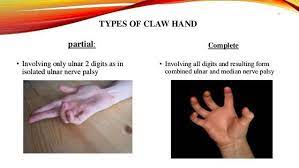 Pin By Sunadh Barnabas On Orthopedics Ulnar Nerve Median Nerve Nerve Palsy
