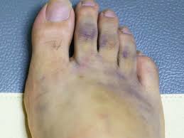 Check spelling or type a new query. Purple Feet Causes And Treatment