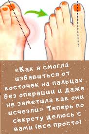 можно ли избавиться от косточки на ноге без операции Pin Na Doske Prochee
