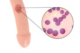 Ist eine hpv impfung wirklich sinnvoll? Hpv Virus Warzen Mann InÈ›elesul Feigwarze In DicÈ›ionarul GermanÄƒ Hpv Virus Warzen Mann