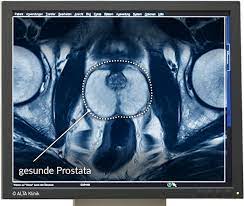 Prostatitis Symptome Anzeichen Behandlung Alta Klinik
