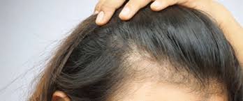 Hair loss treatments for women vary in price based on the formula and the size of the bottle. Symptoms Of Hair Loss Ducray
