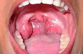 Vidy Anginy U Vzroslyh Foto