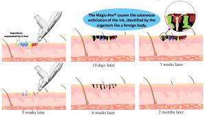Black tattoo pigment absorbs all laser wavelengths, making it the easiest color to treat. Tattoo Removal Device Magic Pen Erasing Tattoos Without Scars Tepr Method