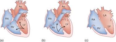 Heart defect pda in a normal, healthy heart, the two main blood vessels, namely the aorta, perfusing the body and the pulmonary artery, perfusing the lungs, are separated. Patent Ductus Arteriosus An Overview Sciencedirect Topics