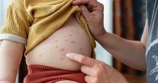 Image result for chickenpox