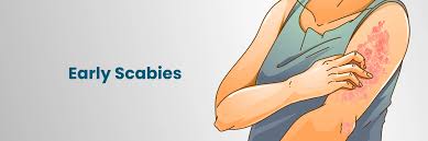 Image result for scabies symptoms