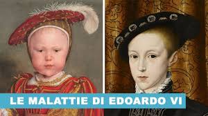 Listen to enrico viii d'inghilterra now. Le Malattie Di Edoardo Vi Re D Inghilterra Figlio Di Enrico Viii Youtube