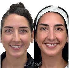 Lip Flip vs Filler: Which is Best Tailored for You? (2025)