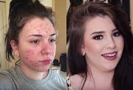 Acne And Iuds Allure