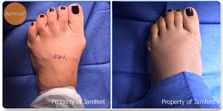 Maybe you would like to learn more about one of these? Before After Bunion Surgery Photo Gallery Los Angeles Foot Doctor Beverly Hills