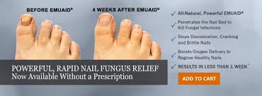 How I Healed My Nail Fungus Read My Story Nail Fungus Toenail Fungus Treatment Toenail Fungus Remedies