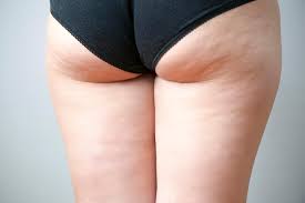 Low prices for cellulite removal in cellulite is the most widespread and topical problem which almost every woman faces nowadays. Running Won T Get Rid Of Your Cellulite But This 5 Step Plan Will Help Banish The Orange Peel