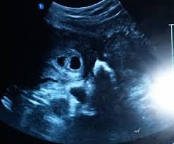 Medically reviewed by valinda riggins nwadike, md, mph — written by scott frothingham on october 27, 2020. Twins Seen At 6 Weeks Via Abdominal Ultrasound Question Babycenter