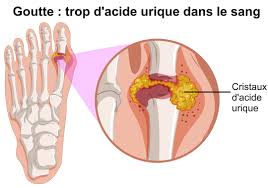 Il consiste à diminuer ou supprimer les aliments riches en purines (abats, gibier, poissons gras, champignons, cacao…) ainsi que l'alcool, à boire des eaux. Hyperuricemie Cause De L Augmentation De L Acide Urique Dans Le Sang