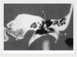 Image result for Ossicular Chain Disruption