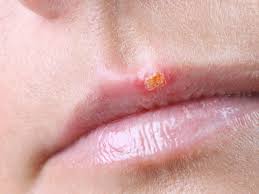 How long does a cold last in adults? When Does A Cold Sore Stop Being Contagious