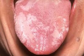 Image result for yellow tongue infection