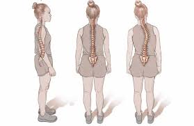 Image result for Muscular Dystrophy