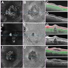 I was diagnosed with central serous retinopathy about 10 years ago. Double Layer Sign And Type 1 Cnv