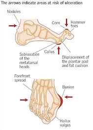 The lunate is dorsally tilted. Management Of Foot Ulceration In Patients With Rheumatoid Arthritis