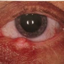 Pin On Ocular Pathophysiology