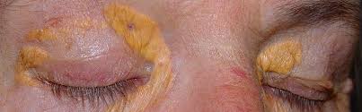 Image result for xantelasma
