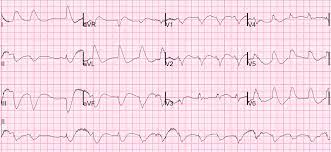 Detecting acute cardiac ischemia in the emergency department: Dr Smith S Ecg Blog Cardiac Arrest Is It Stemi