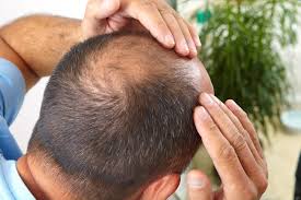 Like other fungal infections, ringworm will weaken the hair follicles, leading to hair shedding. Hair Transplants And Numbness New York Ny