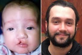 Pediatric Plastic Surgery New Orleans