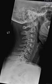 It's commonly done after someone has been in an automobile or other accident. Normal Lateral Cervical Spine Radiograph Radiology Case Radiopaedia Org
