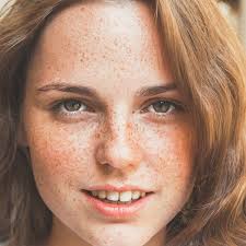 Image result for Freckled skin