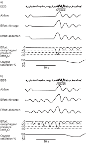 A Central Sleep Apnoea A Stopped Breathing Episode Zero