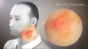 Merkel cell carcinoma (mcc) is a rare type of skin cancer. Basal Cell Carcinoma Shown Explained Using A 3d Medical Animation