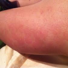 It is all about how the laser is used and how much care is given when it is. Are Laser Hair Removal Burns Permanent Photo