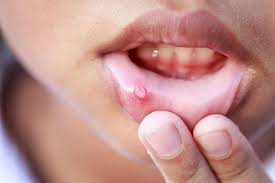 Why Canker Sores Are A Symptom Not A Disease