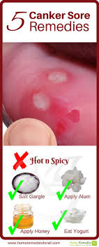 Pin On Home Remedies