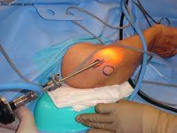 Mr Paul Jarrett Ulnar Neuropathy At The Elbow Cubital Tunnel Syndrome Murdoch Orthopaedic Clinic